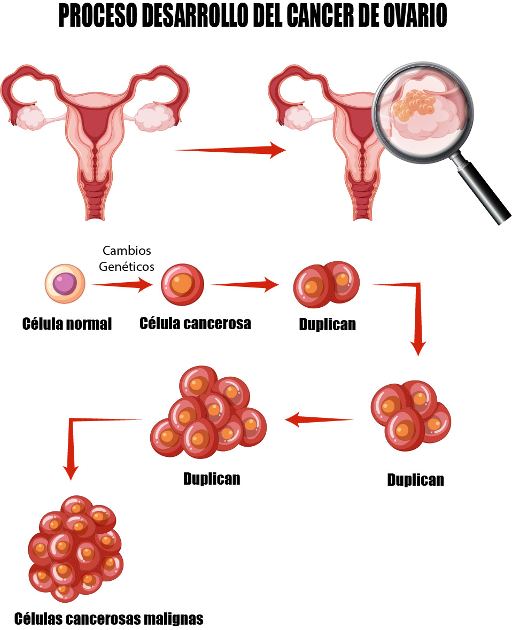 Cáncer de Ovario